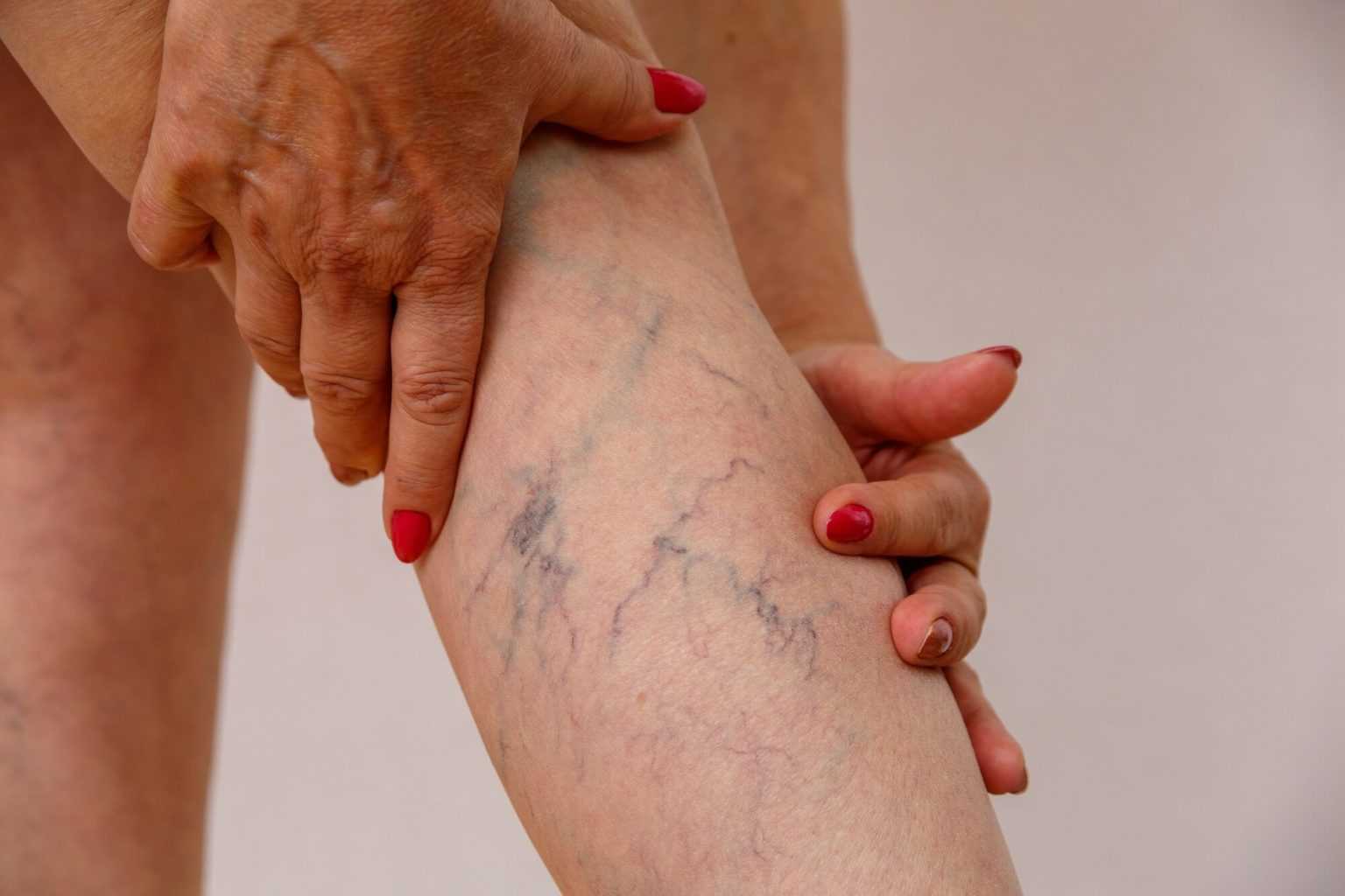 Трофические язвы на ногах: симптомы и лечение